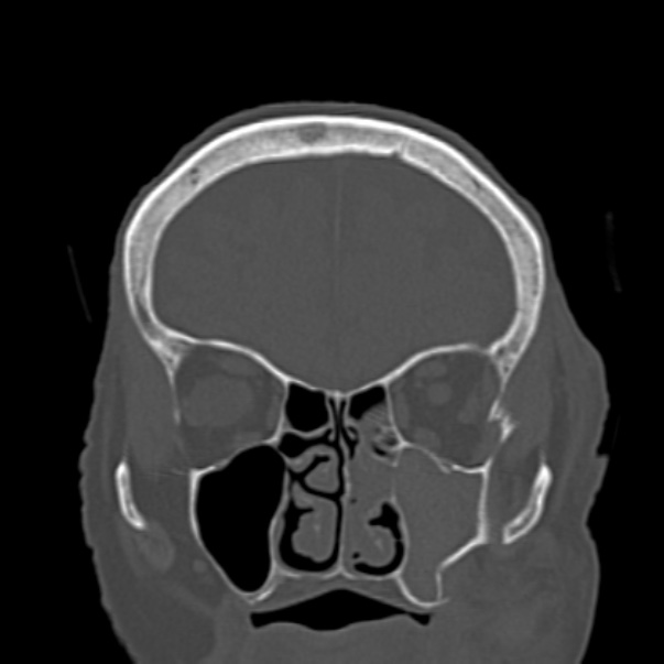 Biparietal osteodystrophy (Radiopaedia 46109-50463 Coronal bone window 30).jpg