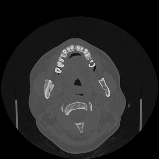 File:Bisphosphonate-related osteonecrosis of the jaw (Radiopaedia 71324-81642 Axial bone window 92).jpg