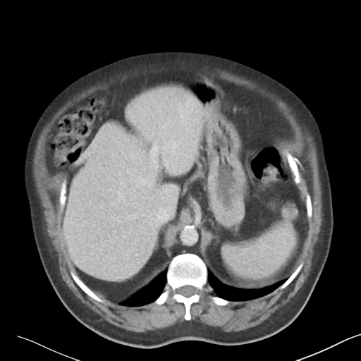 File:Bladder papillary urothelial carcinoma (Radiopaedia 48119-52951 Axial 9).png