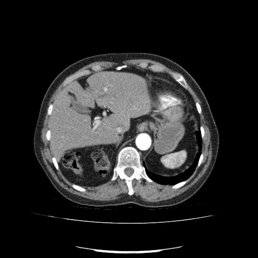 Bladder tumor detected on trauma CT (Radiopaedia 51809-57609 A 80).jpg