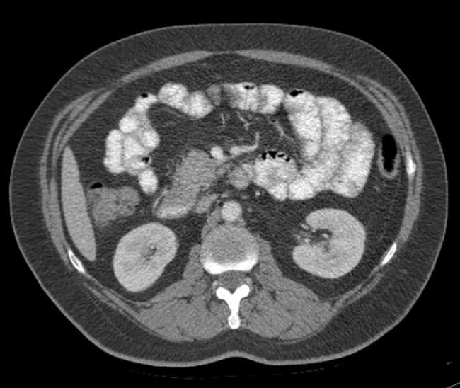 Bleeding duodenal ulcer and adenomyomatosis of gallbladder (Radiopaedia 61834-69861 A 52).jpg