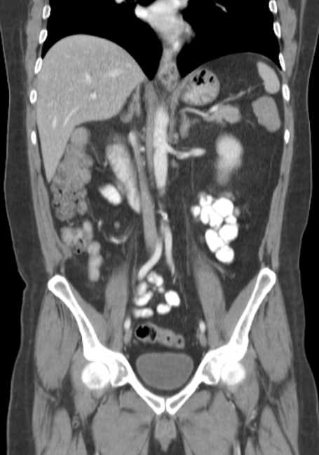 Bleeding duodenal ulcer and adenomyomatosis of gallbladder (Radiopaedia 61834-69861 B 41).jpg