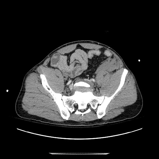 Blunt abdominal trauma with solid organ and musculoskelatal injury with active extravasation (Radiopaedia 68364-77895 A 120).jpg