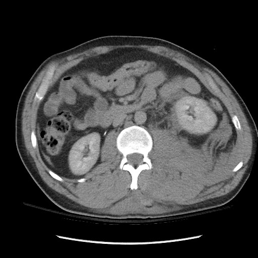 Blunt abdominal trauma with solid organ and musculoskelatal injury with active extravasation (Radiopaedia 68364-77895 Axial C+ delayed 62).jpg