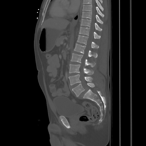 Blunt abdominal trauma with solid organ and musculoskelatal injury with active extravasation (Radiopaedia 68364-77895 Sagittal bone window 52).jpg