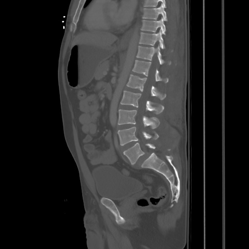 Blunt abdominal trauma with solid organ and musculoskelatal injury with active extravasation (Radiopaedia 68364-77895 Sagittal bone window 55).jpg