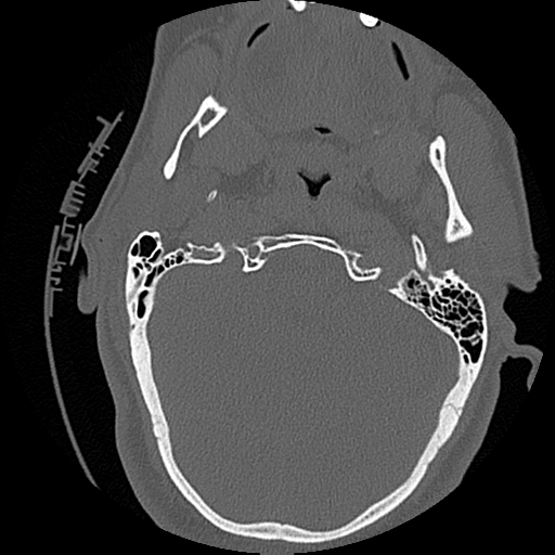 File:Blunt cerebrovascular injury (Radiopaedia 53682-59743 Axial bone window 10).png