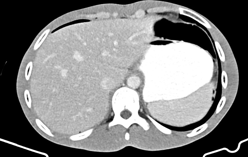 Blunt injury to the small bowel (Radiopaedia 74953-85987 A 14).jpg