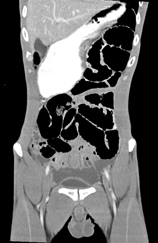 Blunt injury to the small bowel (Radiopaedia 74953-85987 B 28).jpg