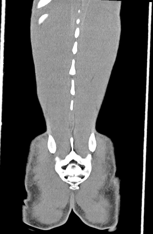 Blunt injury to the small bowel (Radiopaedia 74953-85987 B 89).jpg