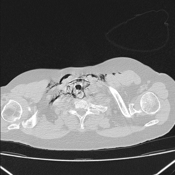 Boerhaave syndrome (Radiopaedia 45644-49799 Axial lung window 24).jpg