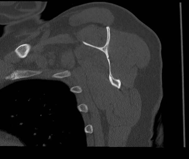 Bony Bankart and Hill-Sachs lesions (Radiopaedia 33622-34727 Sagittal bone window 45).png