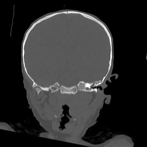 File:Bony atresia of the right external auditory canal (Radiopaedia 27916-28156 Coronal bone window 14).jpg