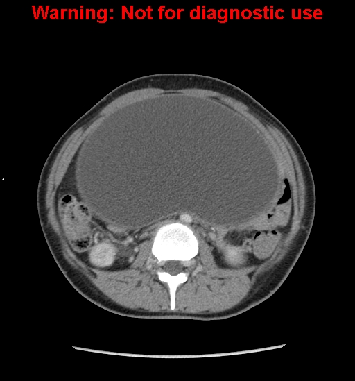 Borderline mucinous cystadenoma of ovary (Radiopaedia 25586-25767 A 22).jpg