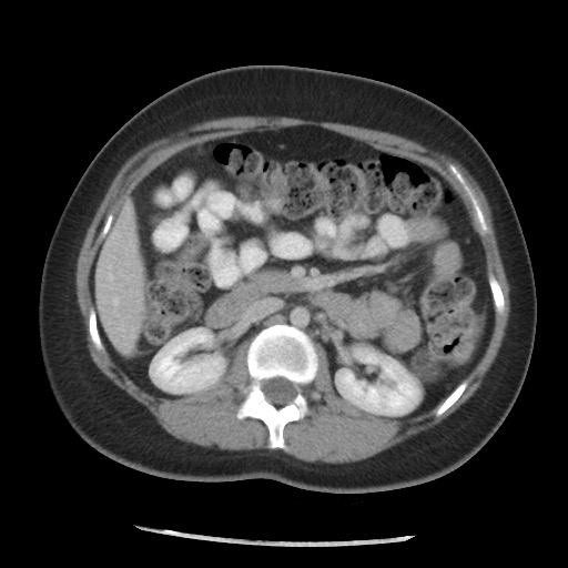 File:Borderline mucinous tumor (ovary) (Radiopaedia 78228-90808 A 84).jpg