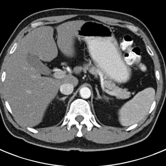File:Bosniak cyst - type IV (Radiopaedia 23525-23627 renal cortical phase 4).jpg