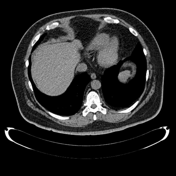 File:Bosniak renal cyst - type IV (Radiopaedia 24244-24518 Axial non-contrast 36).jpg