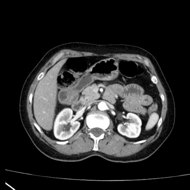 Bosniak renal cyst - type I (Radiopaedia 27479-27675 renal cortical phase 28).jpg