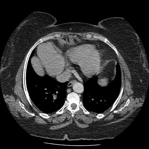 Bovine aortic arch - right internal mammary vein drains into the superior vena cava (Radiopaedia 63296-71875 A 114).jpg