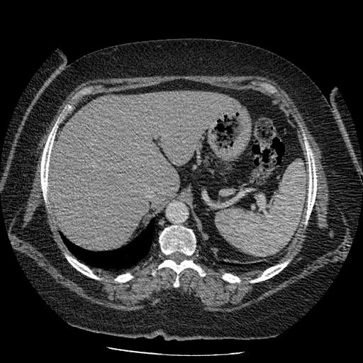 Bovine aortic arch - right internal mammary vein drains into the superior vena cava (Radiopaedia 63296-71875 A 159).jpg