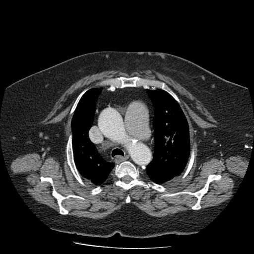 Bovine aortic arch - right internal mammary vein drains into the superior vena cava (Radiopaedia 63296-71875 A 43).jpg