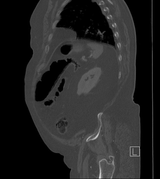 Bowel ischemia secondary to SMA occlusion with extensive portomesenteric venous gas (Radiopaedia 54656-60871 Sagittal bone window 22).jpg