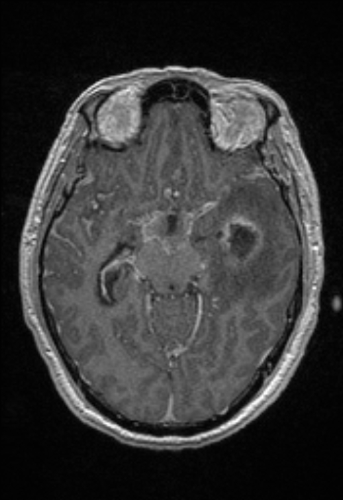 Brain abscess with ventriculitis (Radiopaedia 85703-101495 Axial T1 C+ 76).jpg