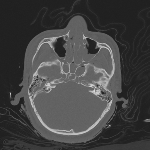 Brain contusions, internal carotid artery dissection and base of skull fracture (Radiopaedia 34089-35339 Axial bone window 56).png