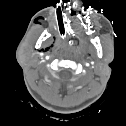 Brain contusions, internal carotid artery dissection and base of skull fracture (Radiopaedia 34089-35339 D 58).png
