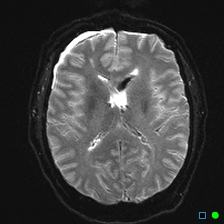 File:Brain death on MRI and CT angiography (Radiopaedia 42560-45689 Axial ADC 19).jpg