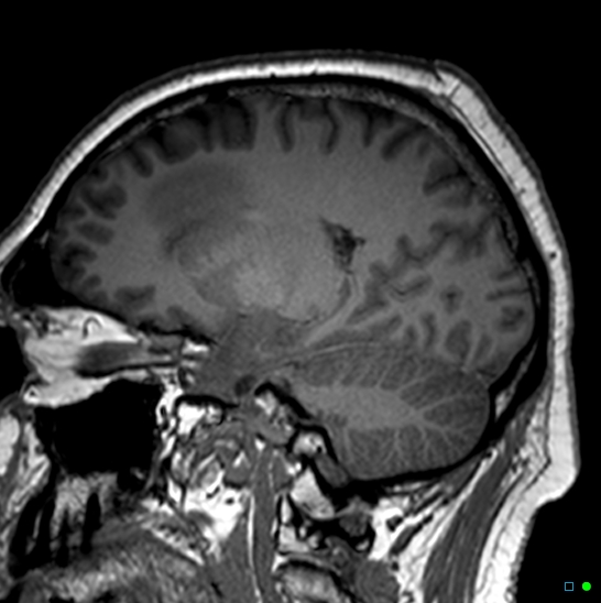 Brain death on MRI and CT angiography (Radiopaedia 42560-45689 Sagittal T1 6).jpg
