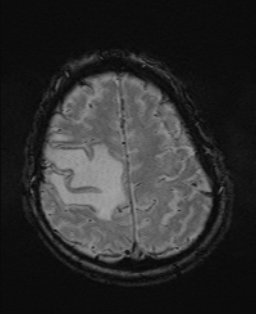 Brain metastases - lung cancer primary (Radiopaedia 75060-86115 Axial SWI 49).jpg