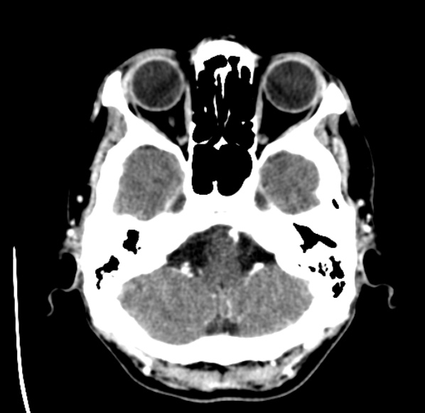 File:Brain metastases from lung cancer (Radiopaedia 24480-24781 Axial C+ delayed 8).jpg