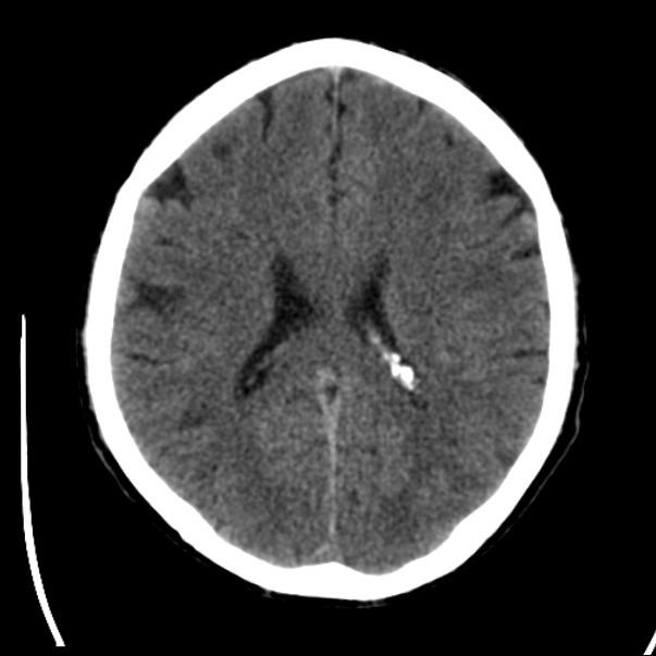 Brain metastases from lung cancer (Radiopaedia 24480-24781 Axial non-contrast 30).jpg