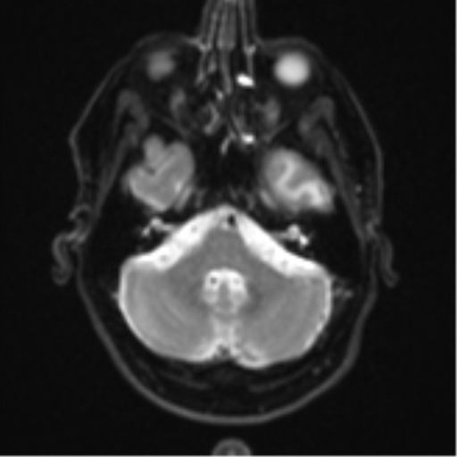 File:Brain metastasis (large cystic mass) (Radiopaedia 47497-52107 Axial DWI 6).png