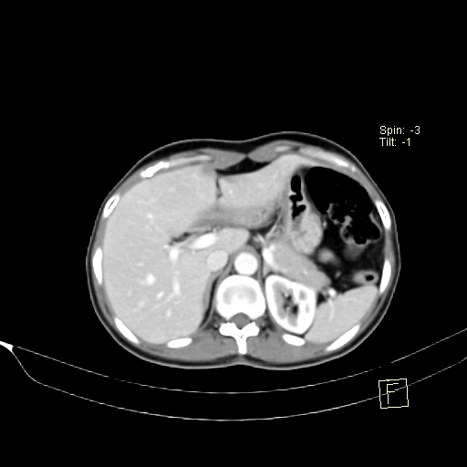 Brain metastasis as initial presentation of non-small cell lung cancer (Radiopaedia 65122-74127 A 49).jpg