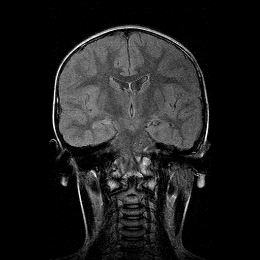 File:Brainstem ganglioglioma (Radiopaedia 10763-11224 Coronal FLAIR 10).jpg