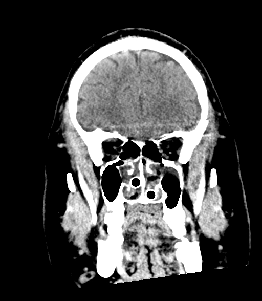Brainstem hemorrhage (Radiopaedia 81294-94976 Coronal non-contrast 17).jpg