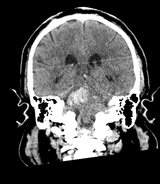 Brainstem hemorrhage (Radiopaedia 81294-94976 Coronal non-contrast 43).jpg