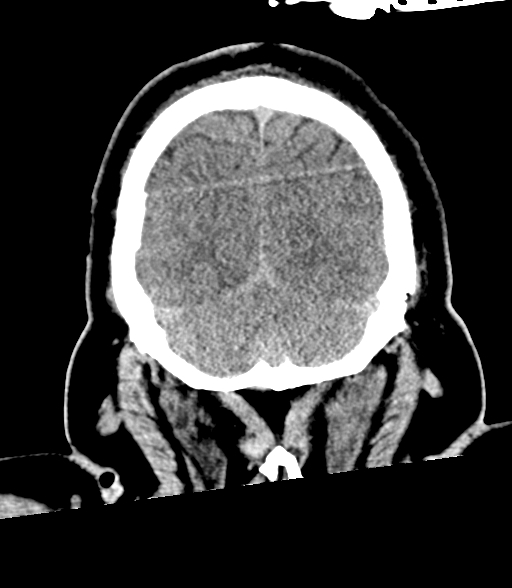 Brainstem hemorrhage (Radiopaedia 81294-94976 Coronal non-contrast 58).jpg
