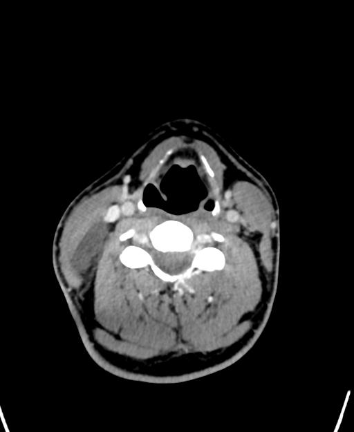 Branchial cleft cyst (Radiopaedia 31167-31875 Axial C+ delayed 36).jpg