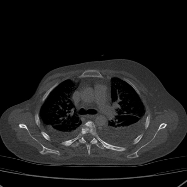Breast cancer metastases - hepatic and skeletal (Radiopaedia 34201-35461 Axial bone window 15).jpg