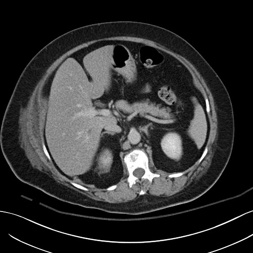 File:Breast carcinoma with pathological hip fracture (Radiopaedia 60314-67974 B 19).jpg