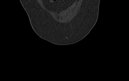 Breast carcinoma with pathological hip fracture (Radiopaedia 60314-67993 Coronal bone window 25).jpg