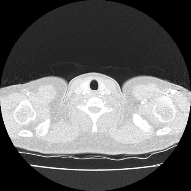 Bronchial atresia (Radiopaedia 22965-22992 Axial lung window 54).jpg