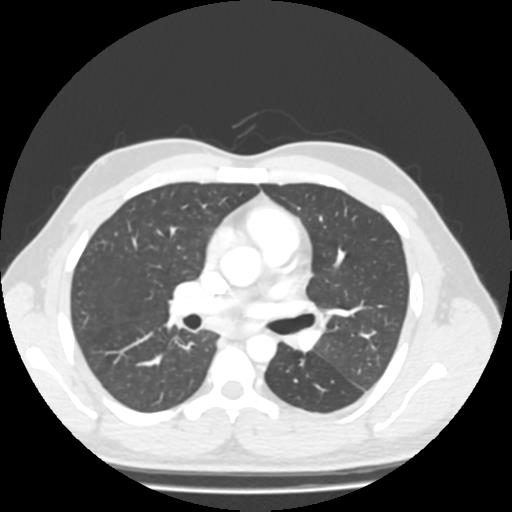 Bronchial carcinoid (Radiopaedia 80013-93291 Axial lung window 53).jpg