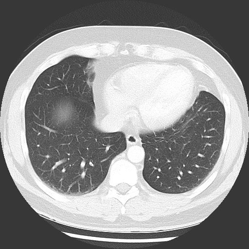 Bronchial carcinoid tumor (Radiopaedia 67377-76764 Axial lung window 45).jpg