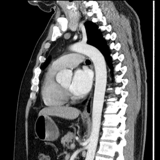 Bronchial carcinoid tumor (Radiopaedia 67377-76764 E 39).jpg