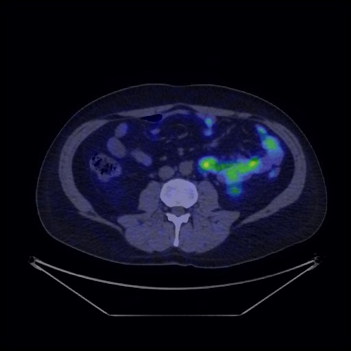 Bronchial carcinoid tumor (Radiopaedia 67377-76765 68Ga-DOTATATE PET-CT 54).jpg