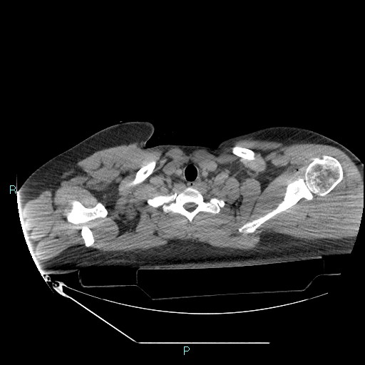 Bronchial carcinoid tumor (Radiopaedia 78272-90870 Axial non-contrast 5).jpg
